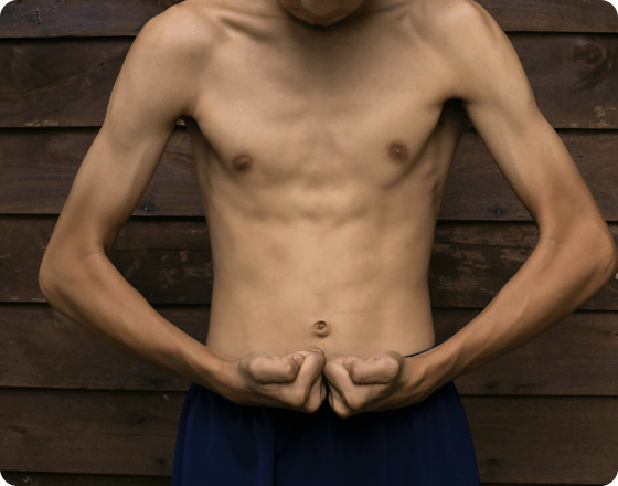 Loss of Muscle Mass